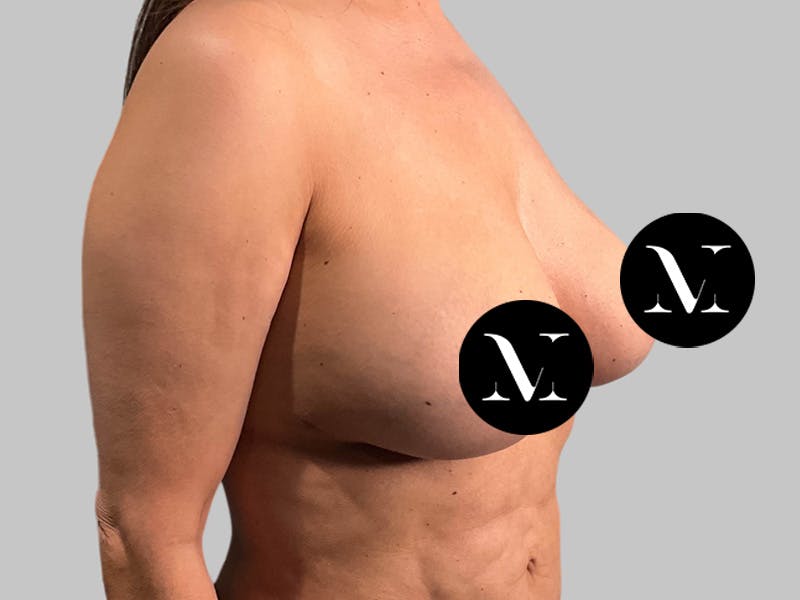 Breast Augmentation-Mastopexy Before & After Gallery - Patient 258371 - Image 4