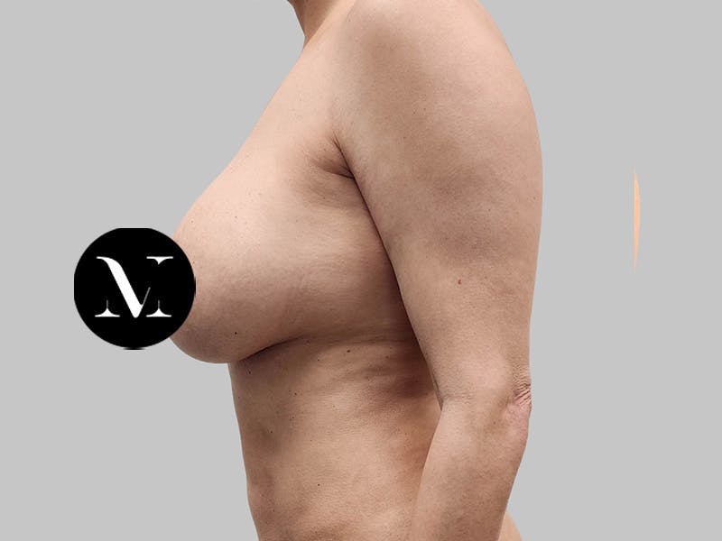 Breast Augmentation-Mastopexy Before & After Gallery - Patient 258371 - Image 9