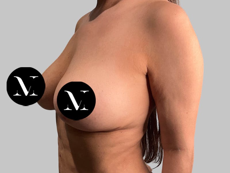 Breast Augmentation-Mastopexy Before & After Gallery - Patient 258371 - Image 8