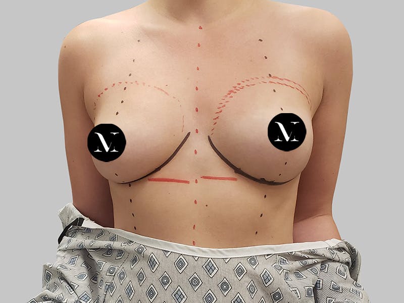 Breast Augmentation Before & After Gallery - Patient 148952 - Image 1