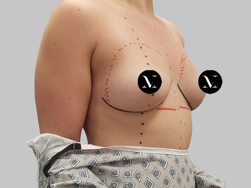 Breast Augmentation Before & After Gallery - Patient 148952 - Image 3