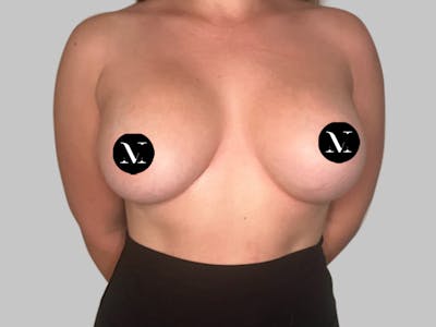 Breast Augmentation Before & After Gallery - Patient 148952 - Image 2