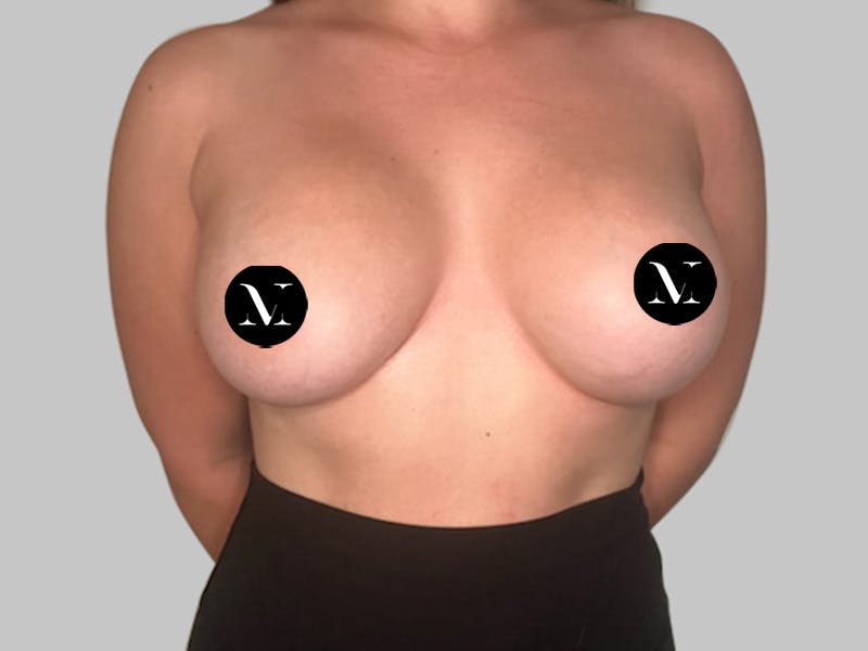 Breast Augmentation Before & After Gallery - Patient 148952 - Image 2