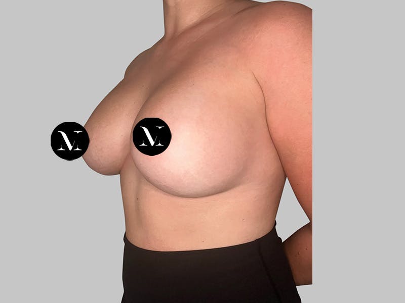 Breast Augmentation Before & After Gallery - Patient 148952 - Image 6