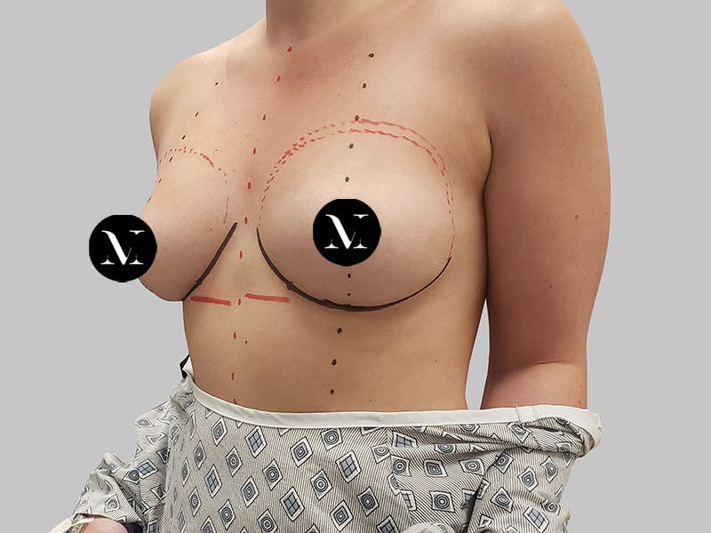 Breast Augmentation Before & After Gallery - Patient 148952 - Image 5