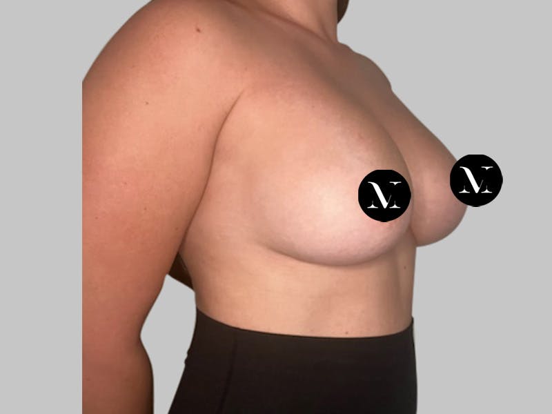 Breast Augmentation Before & After Gallery - Patient 148952 - Image 4