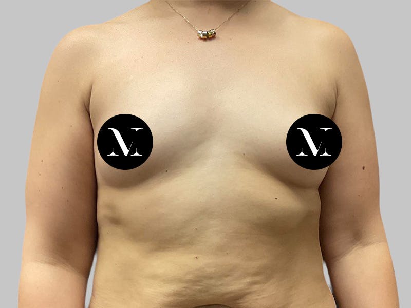 Breast Augmentation Before & After Gallery - Patient 386805 - Image 1