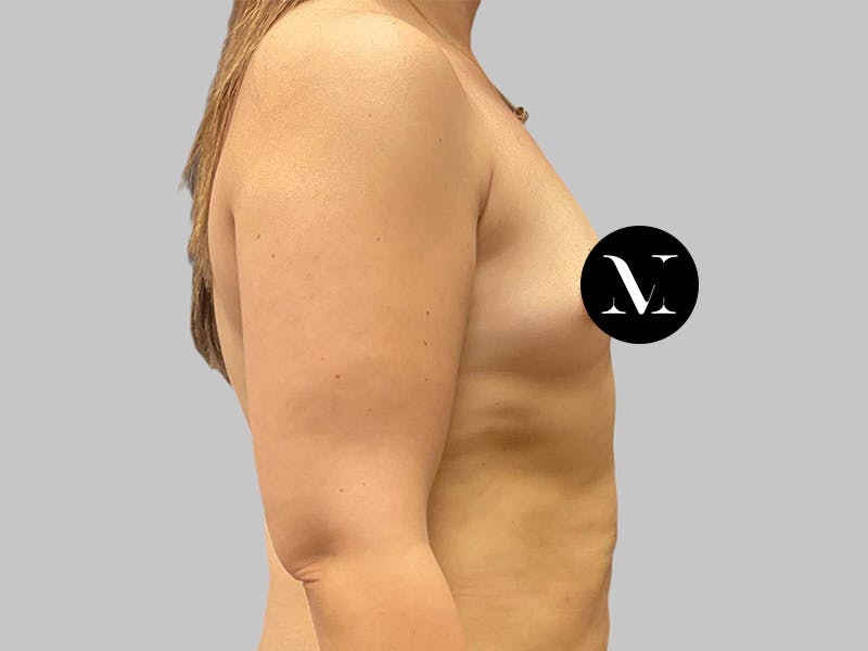 Breast Augmentation Before & After Gallery - Patient 386805 - Image 3