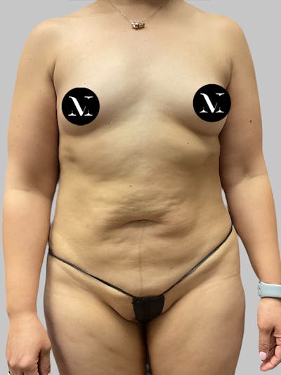 Tummy Tuck Before & After Gallery - Patient 191287 - Image 1