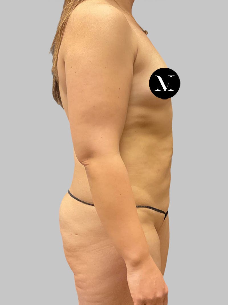 Tummy Tuck Before & After Gallery - Patient 191287 - Image 3