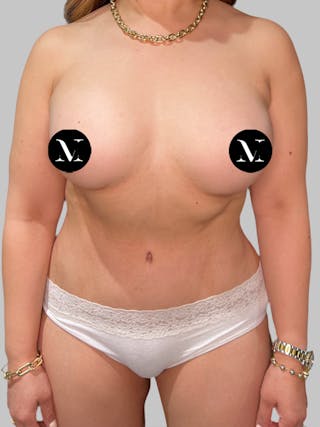Liposuction Before & After Gallery - Patient 137993 - Image 2