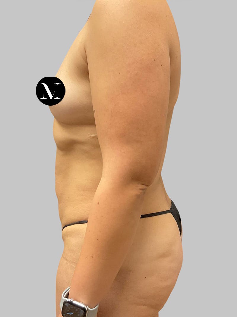 Tummy Tuck Before & After Gallery - Patient 191287 - Image 7