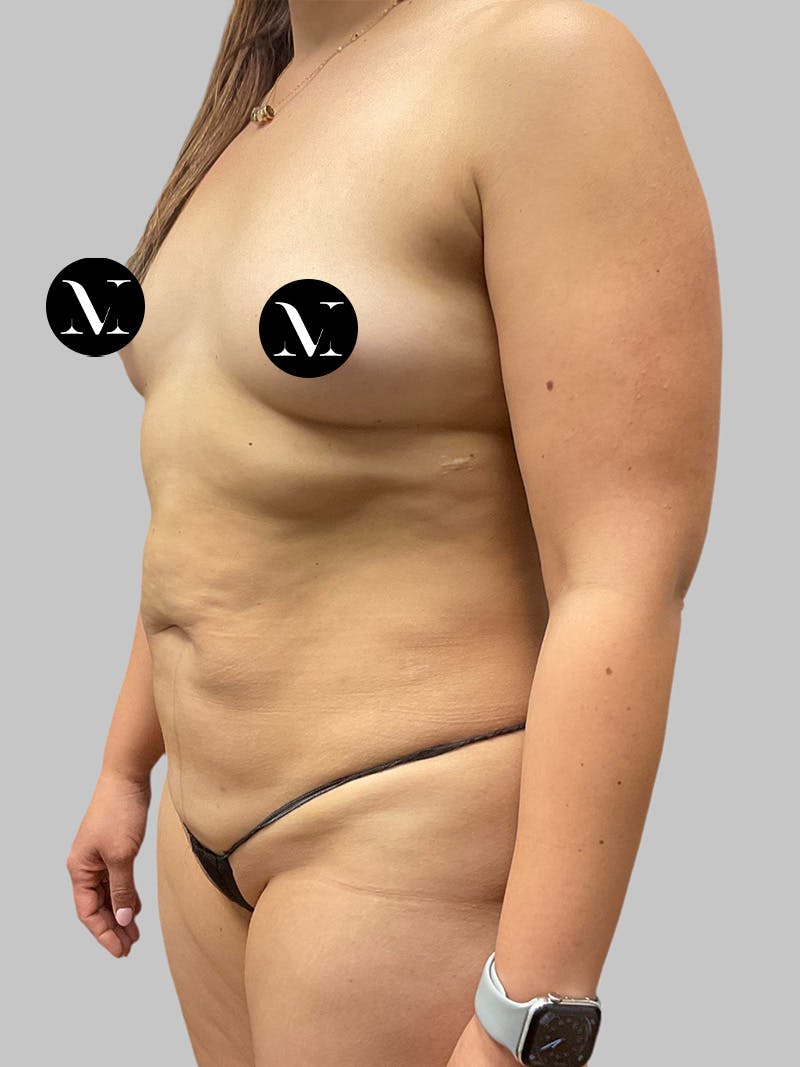 Tummy Tuck Before & After Gallery - Patient 191287 - Image 5