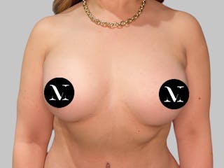 Breast Augmentation Before & After Gallery - Patient 386805 - Image 2