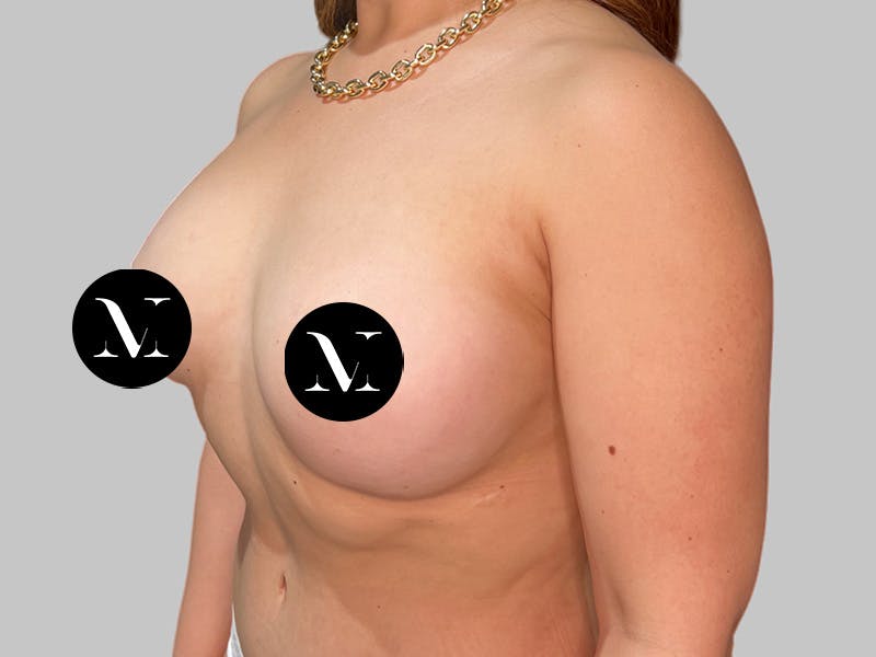 Breast Augmentation Before & After Gallery - Patient 386805 - Image 6