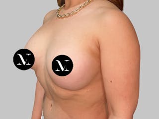 Breast Augmentation Before & After Gallery - Patient 386805 - Image 6