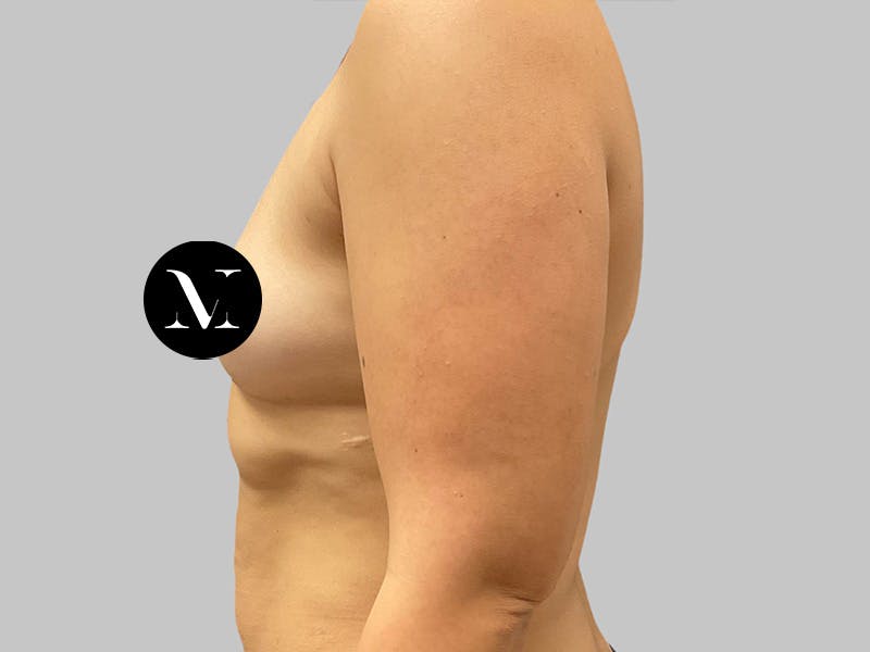 Breast Augmentation Before & After Gallery - Patient 386805 - Image 7