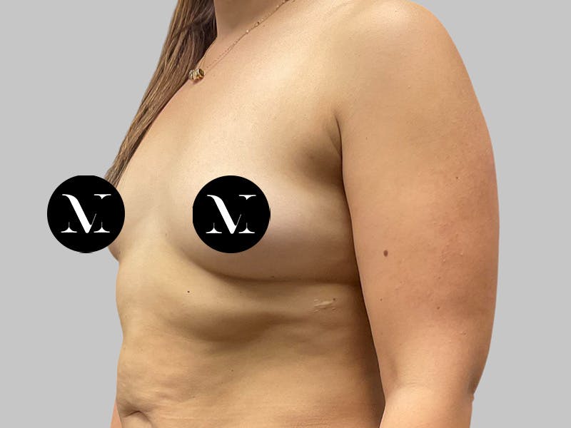 Breast Augmentation Before & After Gallery - Patient 386805 - Image 5