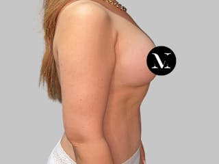 Breast Augmentation Before & After Gallery - Patient 386805 - Image 4