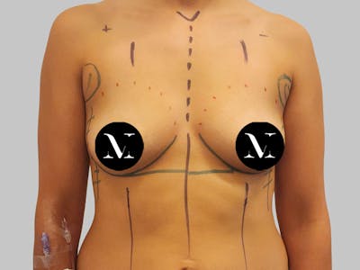 Breast Augmentation Before & After Gallery - Patient 364716 - Image 1