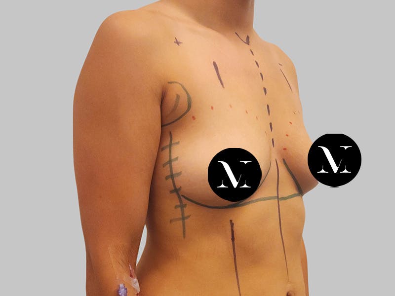 Breast Augmentation Before & After Gallery - Patient 364716 - Image 3