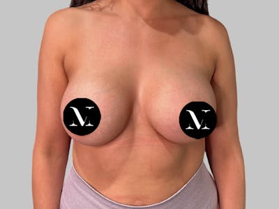 Breast Augmentation Before & After Gallery - Patient 364716 - Image 2