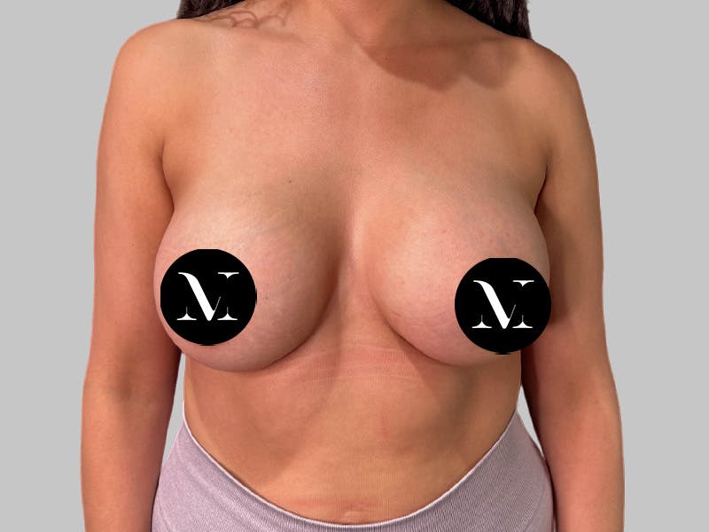Breast Augmentation Before & After Gallery - Patient 364716 - Image 2