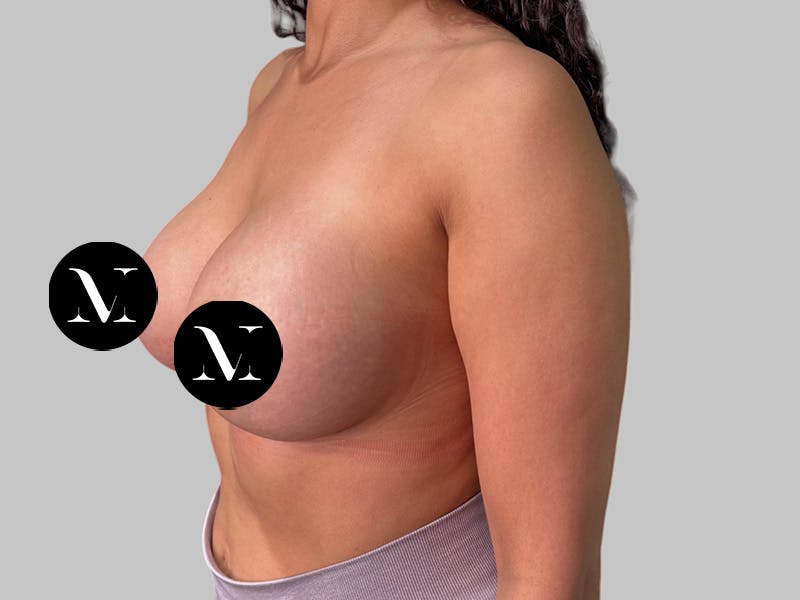 Breast Augmentation Before & After Gallery - Patient 364716 - Image 6