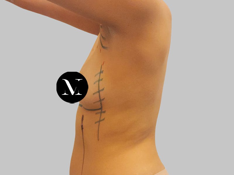 Breast Augmentation Before & After Gallery - Patient 364716 - Image 7