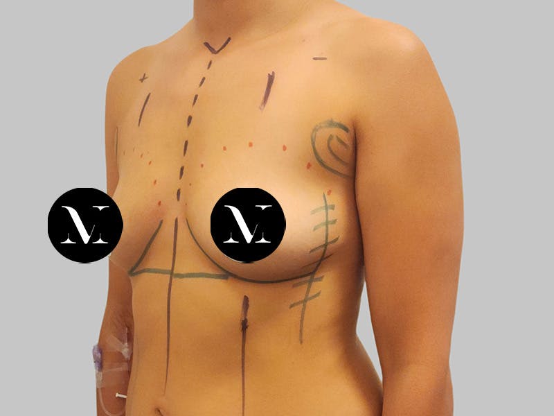 Breast Augmentation Before & After Gallery - Patient 364716 - Image 5