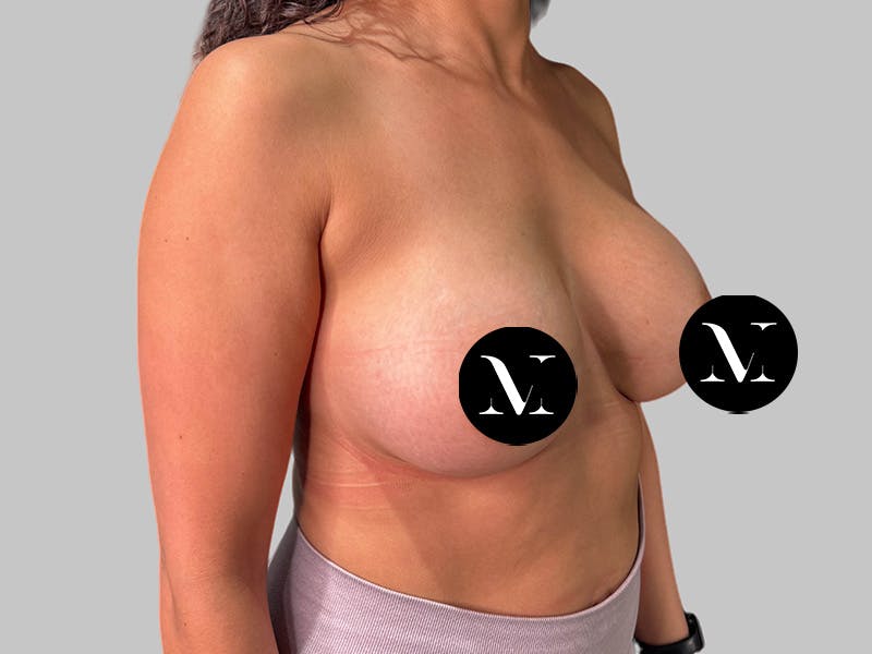 Breast Augmentation Before & After Gallery - Patient 364716 - Image 4