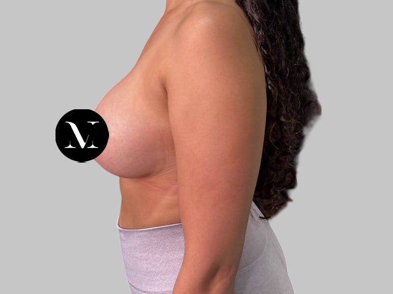 Breast Augmentation Before & After Gallery - Patient 364716 - Image 8
