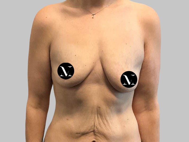Breast Augmentation Before & After Gallery - Patient 382567 - Image 1