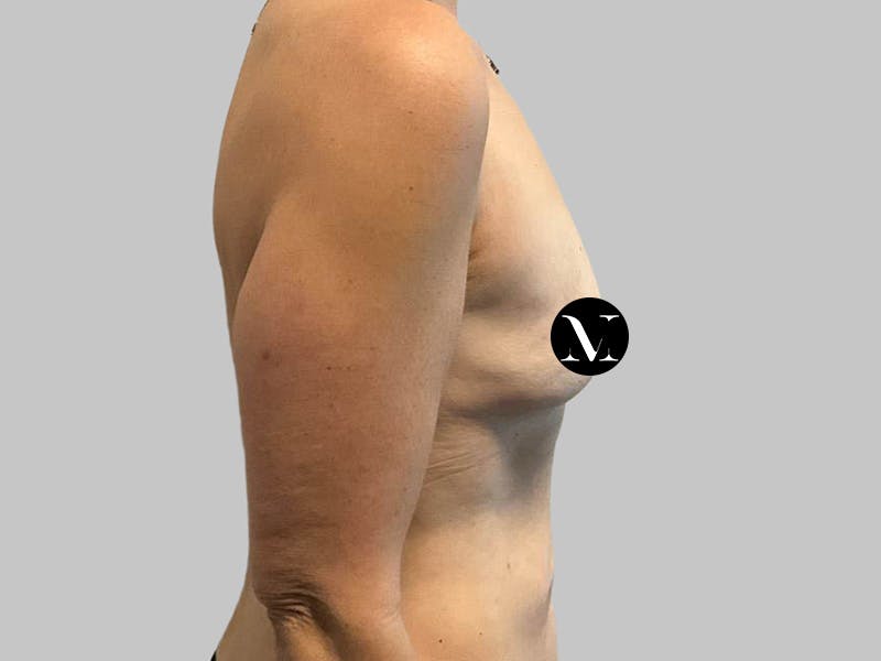 Breast Augmentation Before & After Gallery - Patient 382567 - Image 3