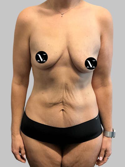 Tummy Tuck Before & After Gallery - Patient 203133 - Image 1