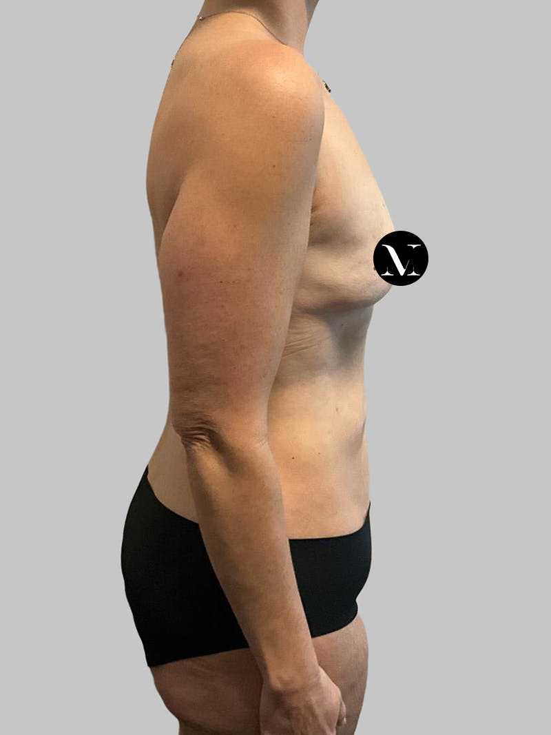 Tummy Tuck Before & After Gallery - Patient 203133 - Image 3