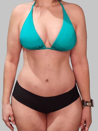 Tummy Tuck Before & After Gallery - Patient 203133 - Image 2