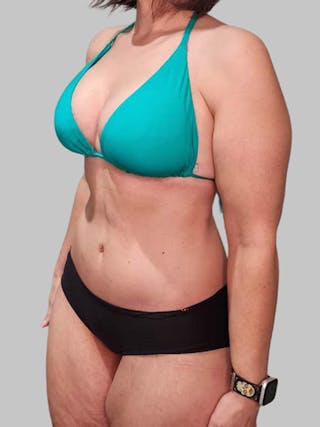 Tummy Tuck Before & After Gallery - Patient 203133 - Image 6