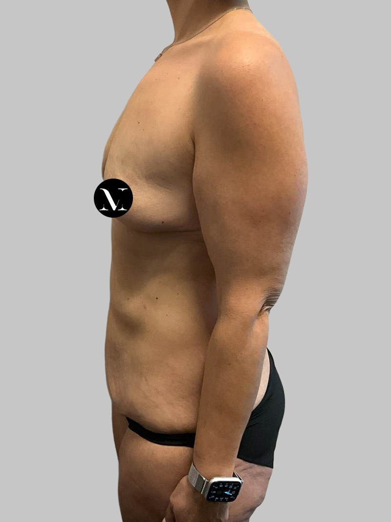 Tummy Tuck Before & After Gallery - Patient 203133 - Image 7