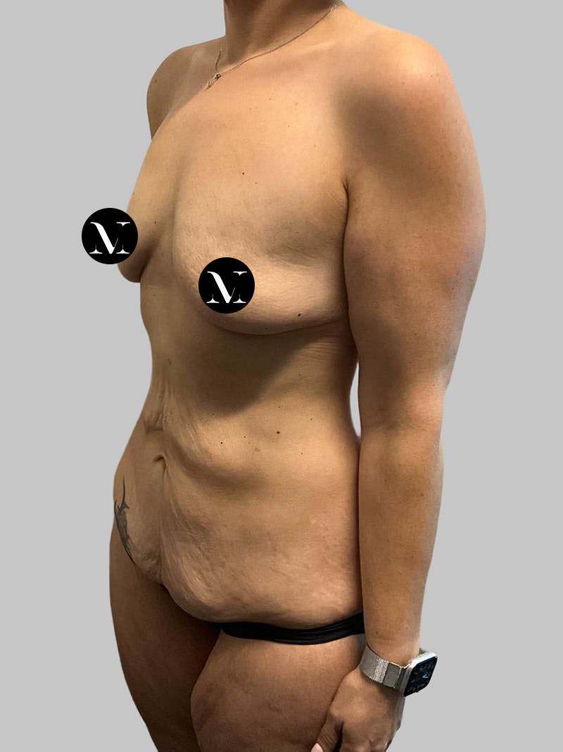 Tummy Tuck Before & After Gallery - Patient 203133 - Image 5
