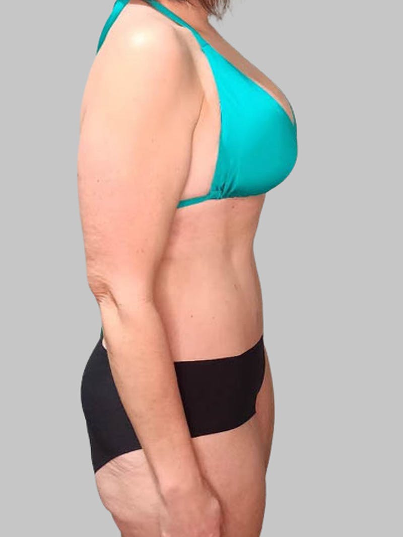 Tummy Tuck Before & After Gallery - Patient 203133 - Image 4