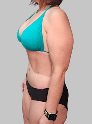 Tummy Tuck Before & After Gallery - Patient 203133 - Image 8