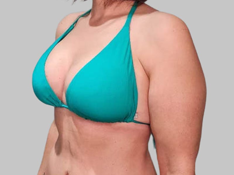 Breast Augmentation Before & After Gallery - Patient 382567 - Image 6