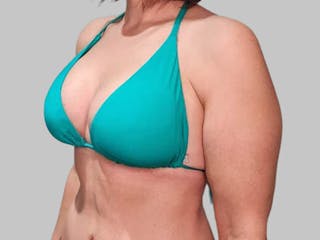 Breast Augmentation Before & After Gallery - Patient 382567 - Image 6