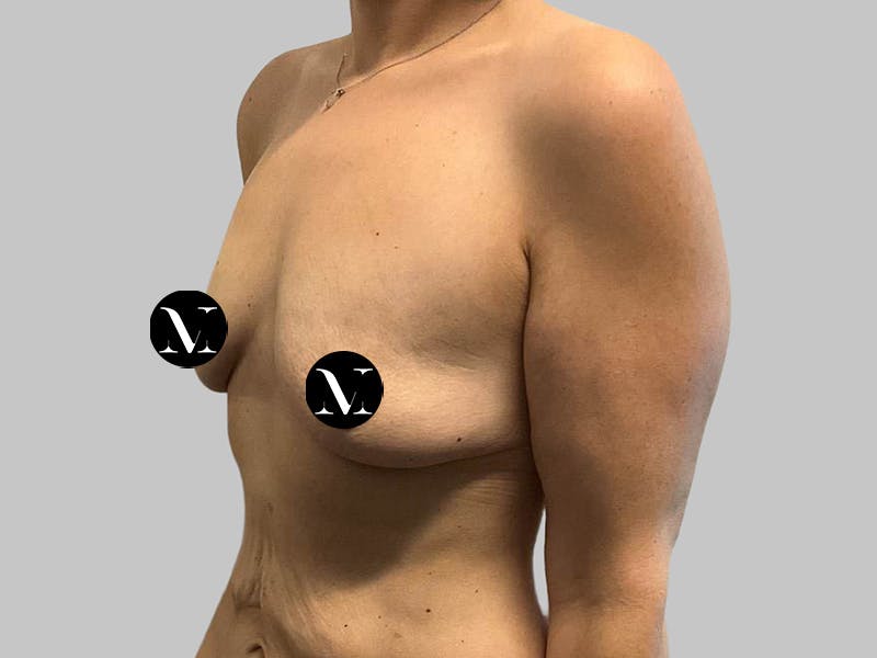 Breast Augmentation Before & After Gallery - Patient 382567 - Image 5