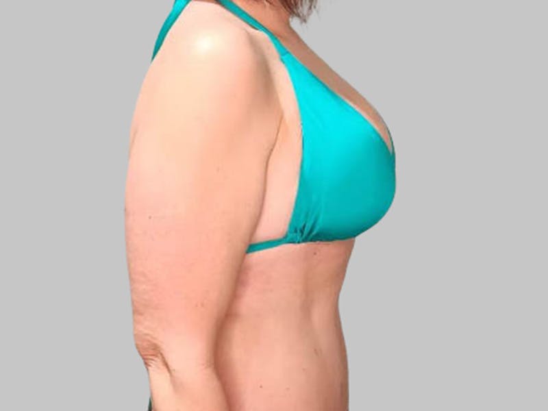 Breast Augmentation Before & After Gallery - Patient 382567 - Image 4