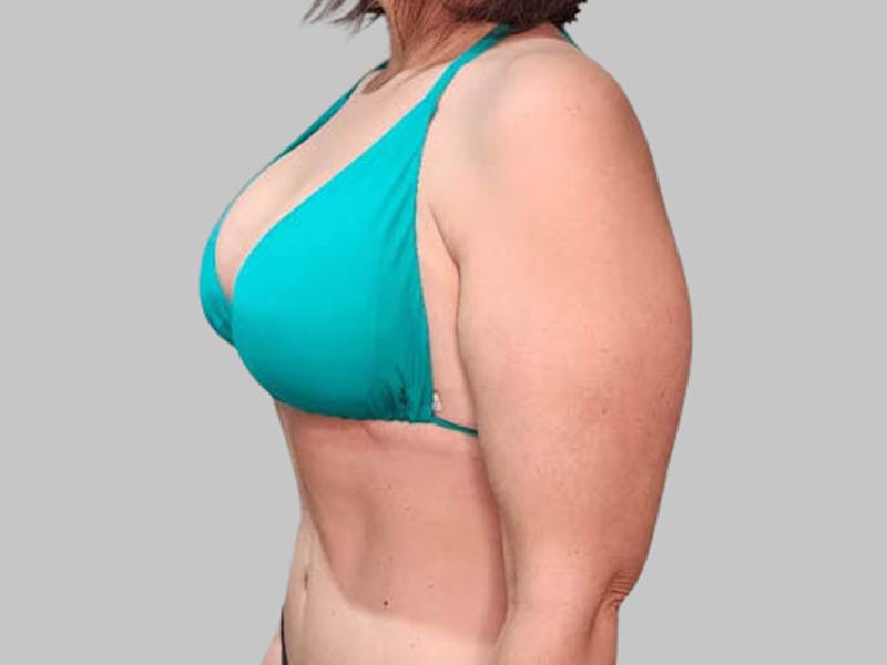 Breast Augmentation Before & After Gallery - Patient 382567 - Image 8