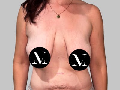 Breast Augmentation Before & After Gallery - Patient 308187 - Image 1