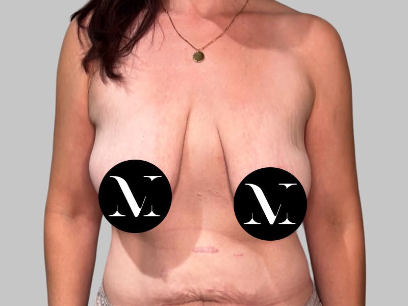 Breast Augmentation Before & After Gallery - Patient 308187 - Image 1