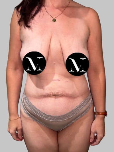Tummy Tuck Before & After Gallery - Patient 426494 - Image 1